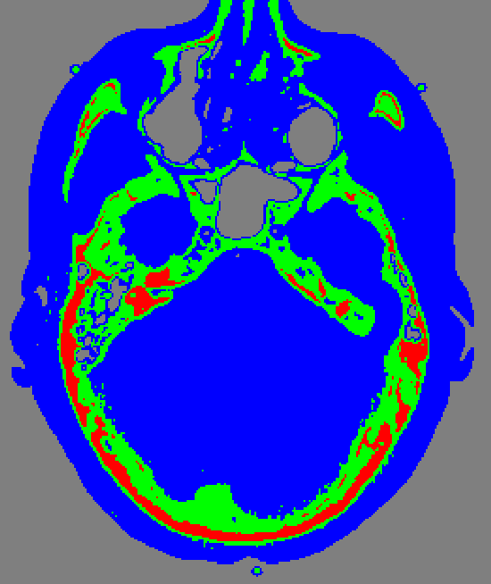 Brain CT