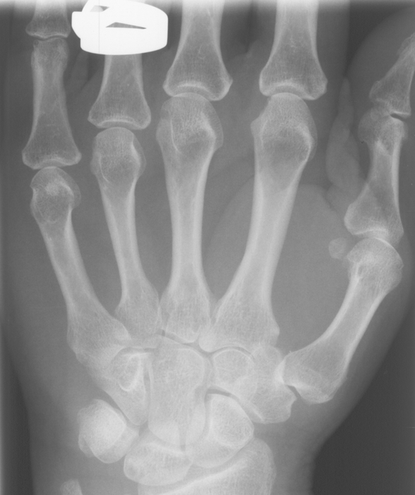 Hand X-ray